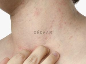 #Mụn Trứng Cá Có Ngứa Không? Có Xử Lý Nhanh Hiệu Quả