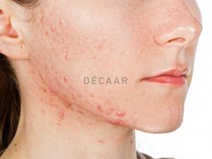 #Mụn Trứng Cá Có Bao Nhiêu Cấp Độ?