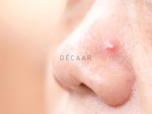 #Mụn Trứng Cá Ở Mũi - Nguyên Nhân & Phương Pháp Điều Trị