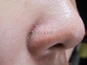 #Mụn Đầu Trắng Là Gì? Giải Pháp Điều Trị Dứt Điểm