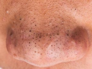 #Cách Trị Mụn Đầu Đen Đơn Giản, Hiệu Quả Mà Bạn Nên Biết