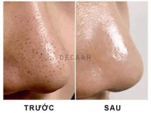 #Cách Trị Mụn Đầu Đen Bằng Phương Pháp Tự Nhiên Mà Bạn Nên Biết
