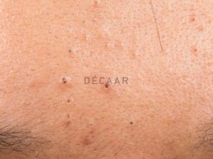 #Mụn Đầu Đen Ở Trán - Cách Ngăn Ngừa Và Điều Trị Hiệu Quả