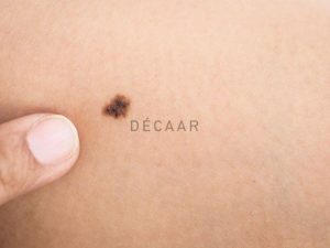 #Mụn Đầu Đen Để Lâu Có Thành Nốt Ruồi Không?