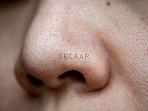 #Phân Biệt Mụn Đầu Đen Và Sợi Bã Nhờn - Giải Pháp Điều Trị
