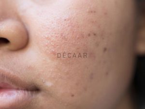 #Cách Trị Mụn Đầu Đen Tuổi Dậy Thì An Toàn Và Hiệu Quả