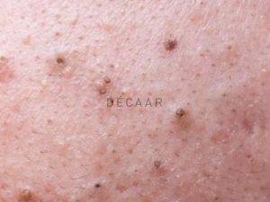 #Có Nên Nặn Mụn Đầu Đen Ở Mũi? Lợi Ích Và Rủi Ro Cần Biết