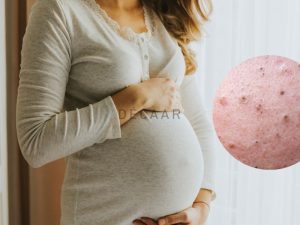 #Cách Trị Mụn Đầu Đen Cho Bà Bầu Hiệu Quả Nhanh Chóng