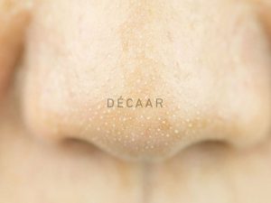#Mụn Cám Là Gì? Nguyên Nhân Và Cách Điều Trị Dứt Điểm
