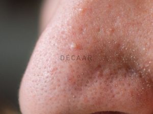 #Cách Trị Mụn Cám Nhanh Chóng Và Hiệu Quả Cho Làn Da