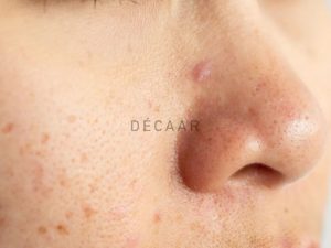 #Mụn Cám Ở Mũi Có Mùi Hôi: Nguyên Nhân Và Cách Xử Lý