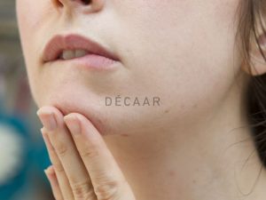 #7 Cách Trị Mụn Cám Ở Cằm Giúp Da Láng Mịn Nhanh Chóng