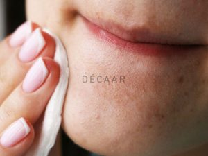 #Mụn Cám Quanh Miệng: Cách Xử Lý Mà Không Gây Tổn Thương Da
