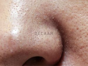#Trị Mụn Cám Cho Da Nhờn: Những Phương Pháp Hiệu Quả Nhất