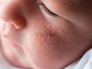 #Mụn Sữa Ở Trẻ Sơ Sinh: Nguyên Nhân Và Cách Xử Lý An Toàn