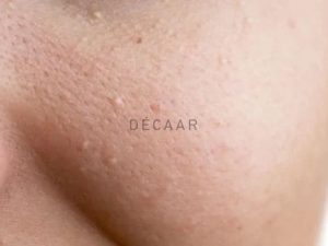 #Top 5+ Cách Đẩy Mụn Ẩn Dưới Da Toàn, Không Gây Tổn Thương Da