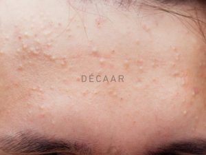 #Cách Trị Mụn Ẩn Tại Nhà An Toàn Mà Đem Lại Hiệu Quả Cao