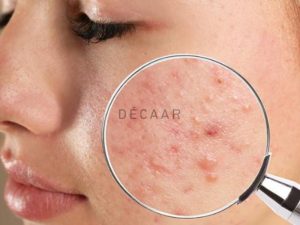 9+ Cách Trị Mụn Ẩn Cho Da Nhạy Cảm Hiệu Quả & An Toàn