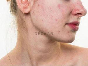 #Cách Trị Mụn Ẩn Ở Má Đơn Giản Mà Đem Lại Hiệu Quả Cao
