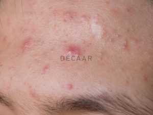 #Mụn Ẩn Sưng Đỏ: Nguyên Nhân Và Cách Xử Lý Hiệu Quả
