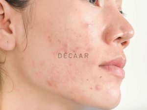 #Mụn Ẩn Ở Má: Nguyên Nhân, Cách Trị Và Ngăn Ngừa Hiệu Quả