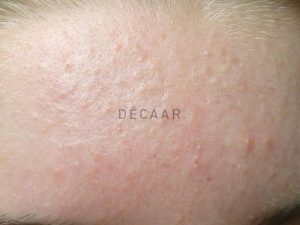 #Mụn Ẩn Trên Trán: Nguyên Nhân và 5 Cách Điều Trị Hiệu Quả
