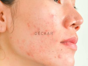 #Glycolic Acid Có Đẩy Mụn Không? Công Dụng & Cách Dùng Hiệu Quả