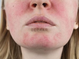 #Tác Dụng Phụ Của BHA: Nguyên Nhân Và Cách Giải Quyết