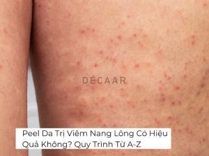 #Peel Da Trị Viêm Nang Có Hiệu Quả Không? Quy Trình Từ A-Z