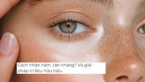 Cách nhận biết sắc tố do nắng khác với nám, tàn nhang