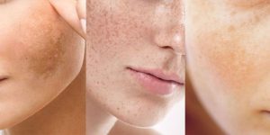 Phân Loại Nám Và Mức Độ Đáp Ứng Với Peel Da - Hiểu Đúng Để Xây Dựng Phác Đồ Hiệu Quả