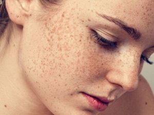 Các Nồng Độ Peel Hóa Học Phù Hợp Cho Từng Cấp Độ Nám