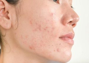 LOGIC XÂY DỰNG PHÁC ĐỒ PHỤC HỒI DA SAU TẾT CHO SPA: 3 BƯỚC KHÔNG THỂ BỎ QUA